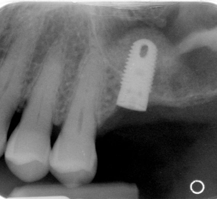 Cosmetic Crown Lengthening