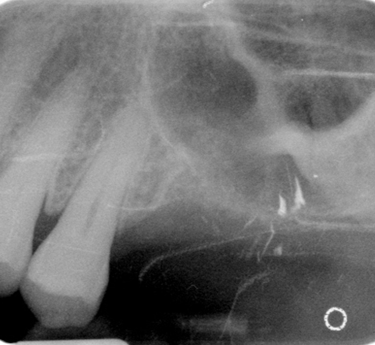 Cosmetic Crown Lengthening
