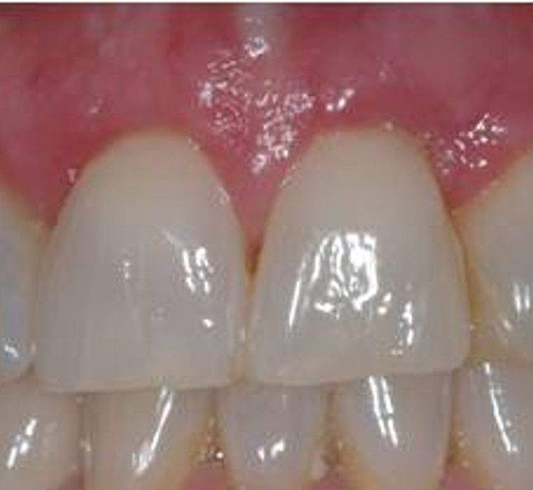 Gingival Grafting 