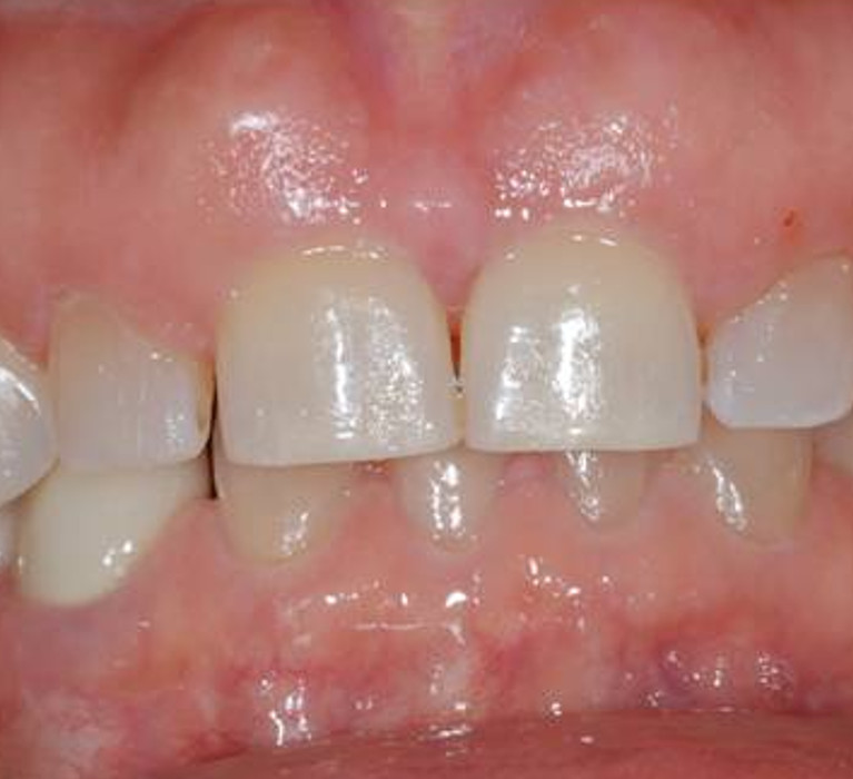 Cosmetic Crown Lengthening