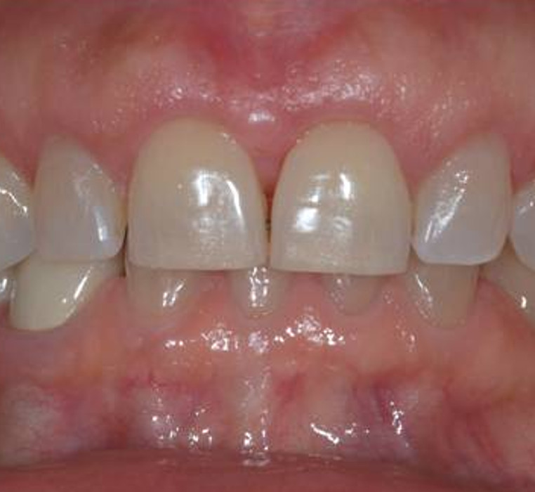 Cosmetic Crown Lengthening