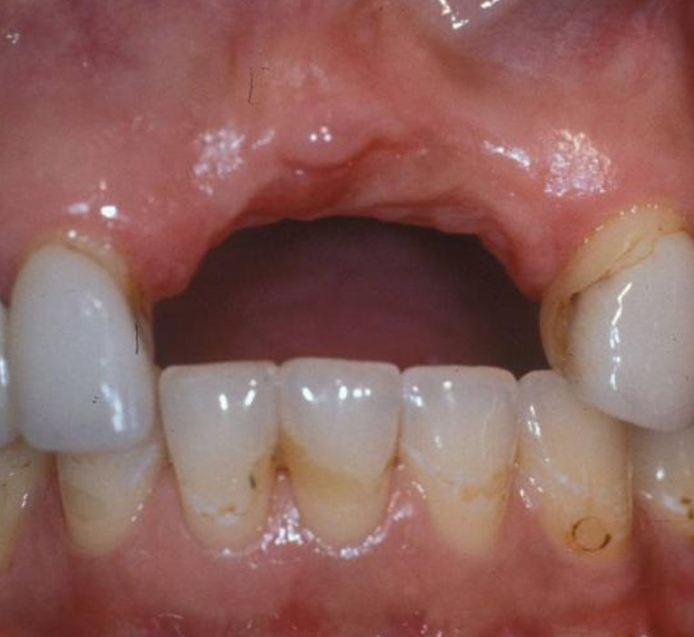 Ridge Augmentation