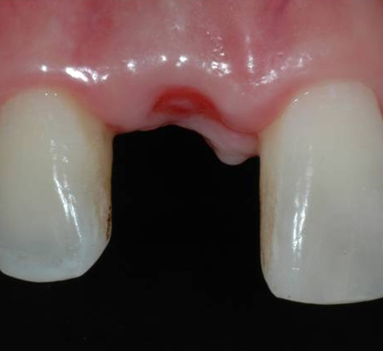 Implant replacement
